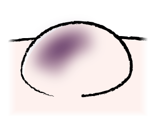 出血が起こった腫瘍の絵
