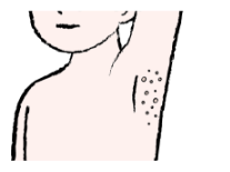 雀卵斑様色素斑（じゃくらんはんようしきそはん）