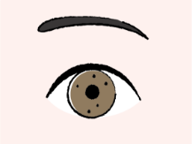 虹彩小結節（こうさいしょうけっせつ）